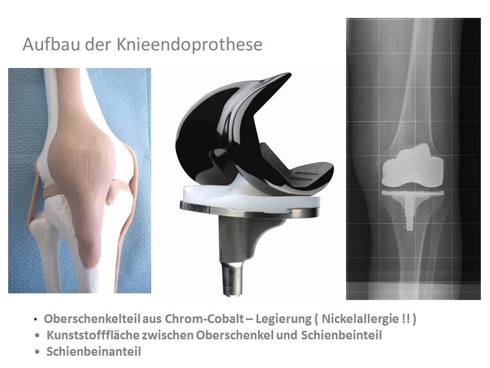 Kniegelenk Endoprothese